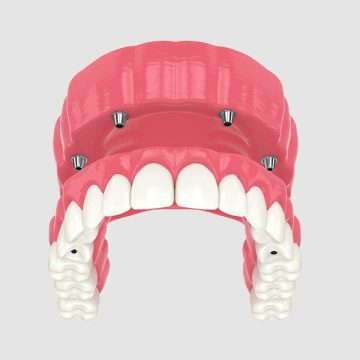 Everything You Need to Know About Full Mouth Reconstruction