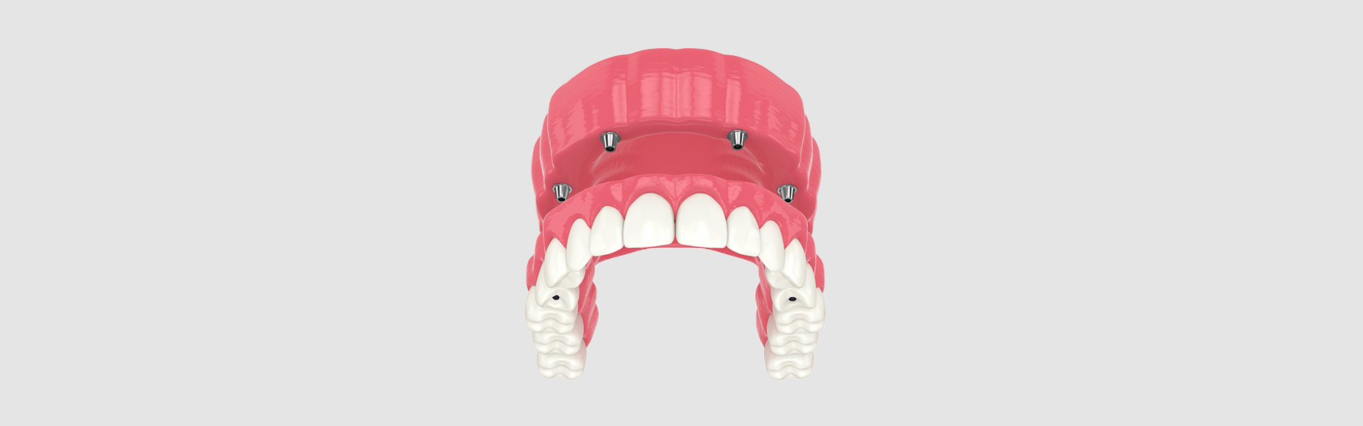 Everything You Need to Know About Full Mouth Reconstruction