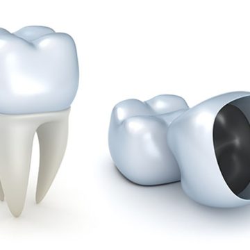 The Role of Dental Crowns in Modern Dentistry